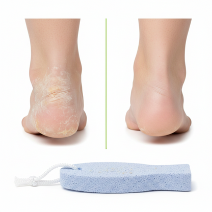 Before and after comparison showing the removal of dry, cracked skin on heels using a blue coarse grit pumice stone shaped like a fish, designed for smooth, healthy feet.